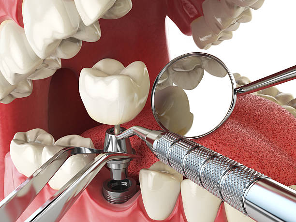 Urgent Tooth Repair in KY